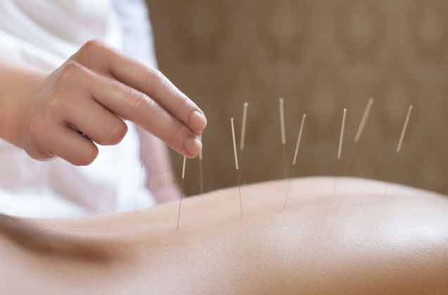 Akupunktur Tedavisi Ne Kadar Sürer, Hangi Sıklıkta Uygulanır?
